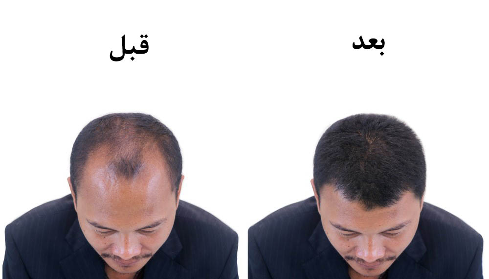 مقایسه کاشت مو در مردان و زنان