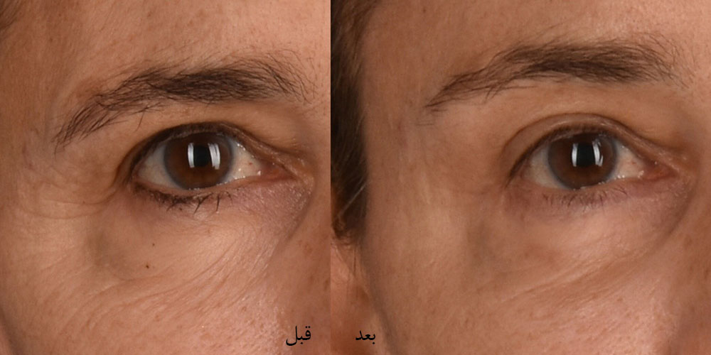 هزینه لیفت دایرکت ابرو