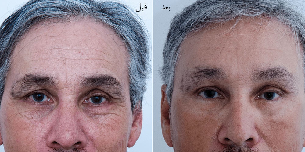 هزینه لیفت دایرکت ابرو