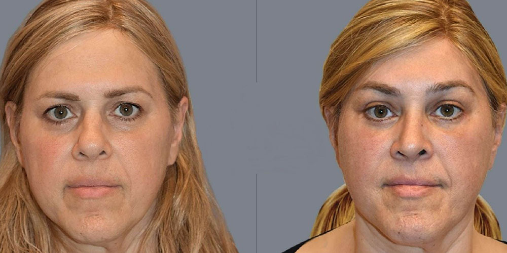 کوتاه کردن پیشانی با کاشت مو