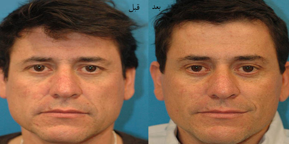لیفت مستقیم ابرو