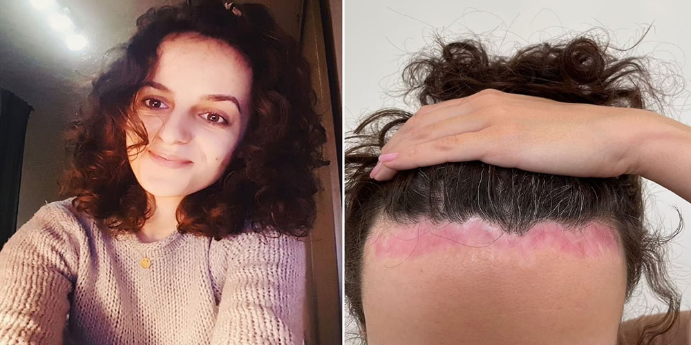 پایین آوردن خط رشد موها با کاشت